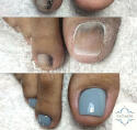 Reconstrucción de uñas del pie